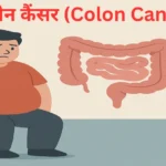 Colon Cancer