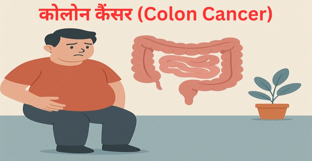 Colon Cancer